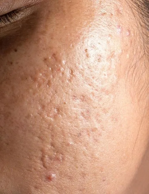 Inkless acne scar repair before and after — face — Olive N Sage Reno NV