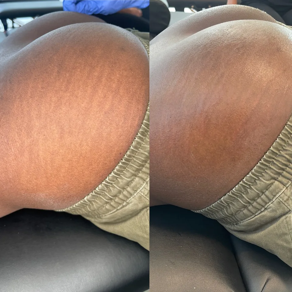 Dark skin tone scar camouflage before and after — Reno paramedical tattoo studio