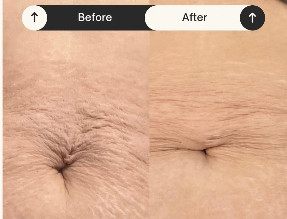 Inkless stretch mark revision before and after — abdomen — Olive N Sage Reno NV